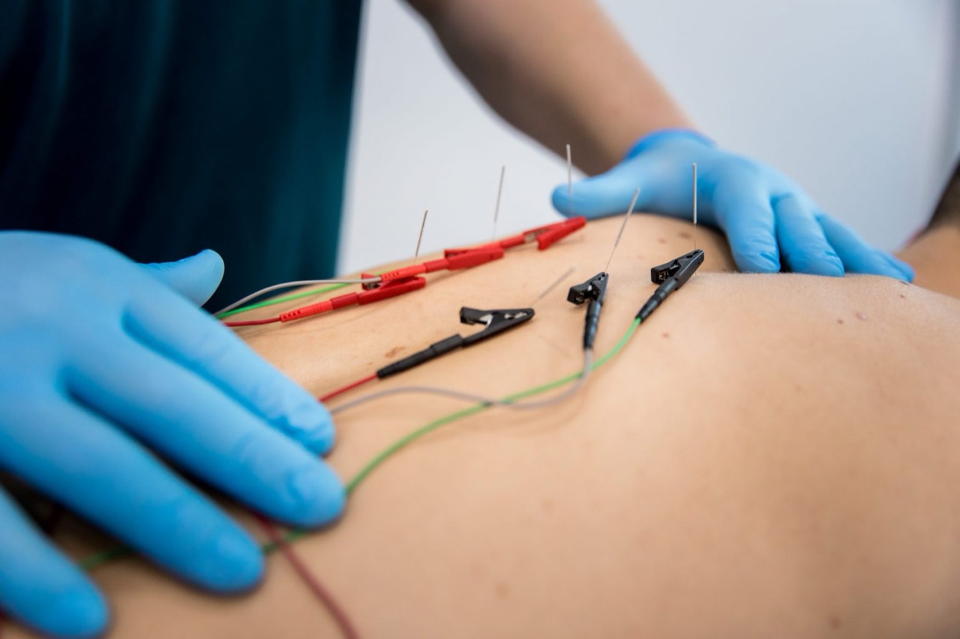 Tratamiento de neuromodulación